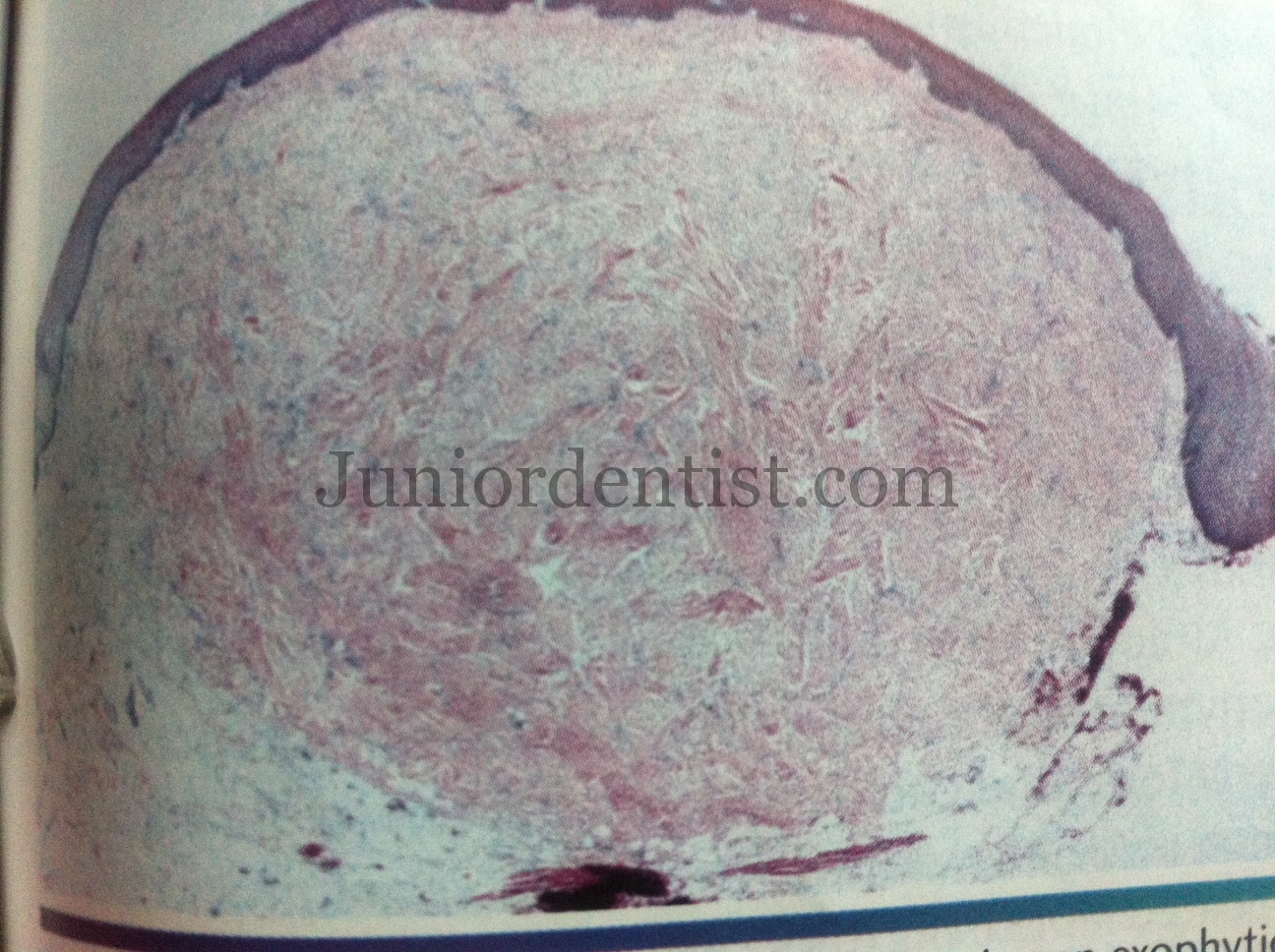 Fibroma of Oral Cavity - Histological features