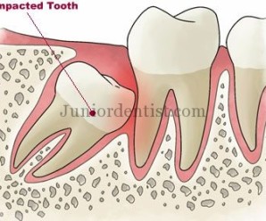 Local Examination for Diagnosis of Impacted 3rd molar