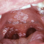 Oral manifestations of hiv or Aids - Candidiasis