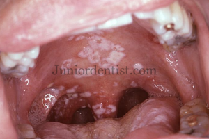 Oral manifestations of hiv or Aids - Candidiasis