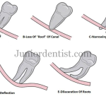 Relation of Inferior alveolar root canal to 3rd molar root tips
