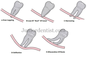 Relation of Inferior alveolar root canal to 3rd molar root tips
