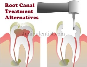 Root canal Treatment alternatives