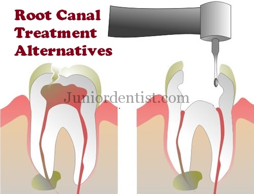 Root canal Treatment alternatives