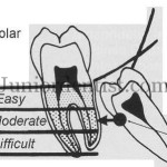 Wharfs Assessment of 3rd molar Impaction winters lines