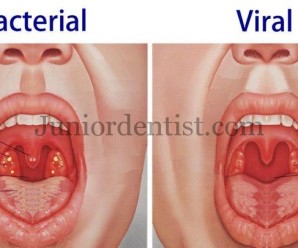 Difference between bacterial and viral tonsillitis