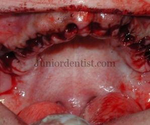 Sequence followed in Full mouth extractions maxillary and mandibular
