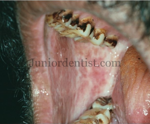 Treatment of Oral Submucous fibrosis
