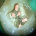 how to remove guttapercha from root canal