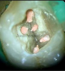 how to remove guttapercha from root canal