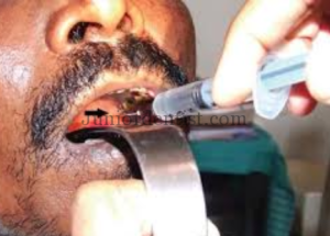 treatment of Oral submucous fibrosis with intra lesional injections