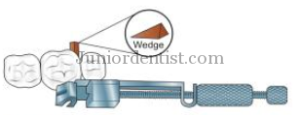 Rapid or immediate tooth separation - wooden wedges
