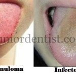 Tongue piercing complications