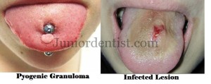 Tongue piercing complications