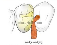 tooth separation with wedge wedging