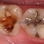 precautions to be taken on loss of Dental filling or restoration