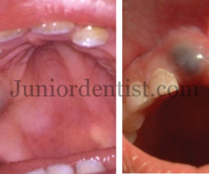 Eruption cyst or Hematoma incisor and molar