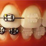how to decide on Orthodontic Treatment - Invisible Braces vs normal braces
