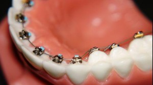 how to decide on Orthodontic Treatment - Lingual Braces