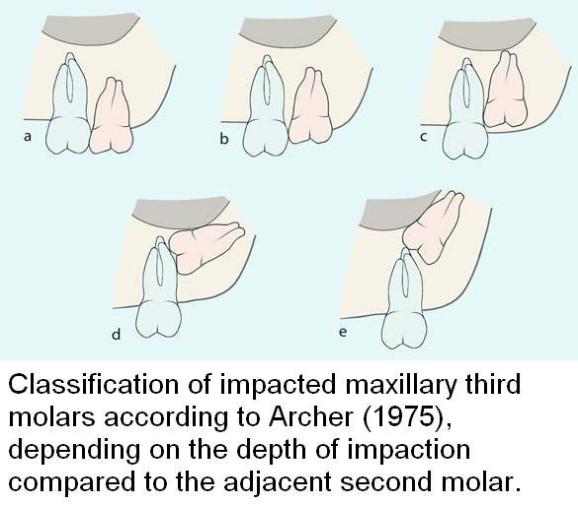 Classification of Maxillary third molar according to depth by archer