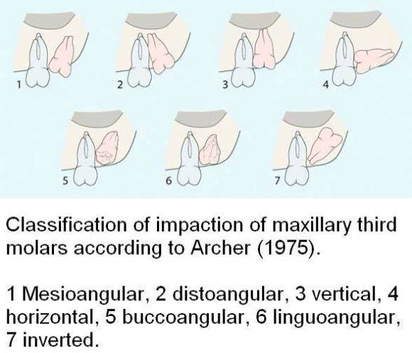Classification  of Maxillay 3rd molar impaction by Archer