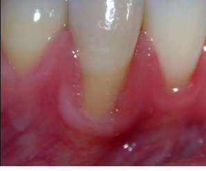 Single tooth gingival recession