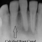 how to find calcified root canals