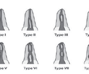 Vertucci et al Classification of Root Canal Morphology
