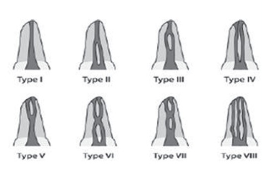  Vertucci et al Classification of Root Canal Morphology