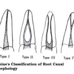 Weines Classification of Root Canal Morpholog