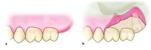How to give horizontal or envelope flap for removal of impacted maxillary third molar