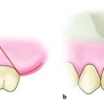 how to give Vertical Flap for extraction of maxillary third molar