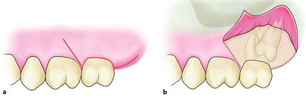 how to give extended Vertical Flap for extraction of maxillary third molar