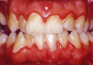 Relation of gingival disease with general health