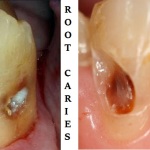 Root caries classification features and treatement