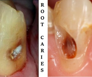 Root caries classification features and treatement