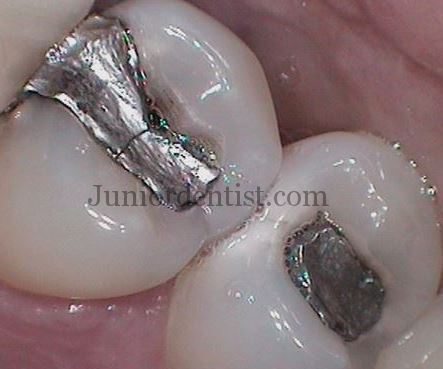 Pain after dental filling or restoration