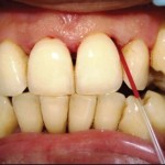 Gingival Crevicular blood can be used to screen diabetes