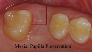 Mesial papilla preservation flap for dental implants
