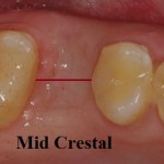 Mid crestal typs flap design for dental implants