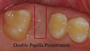 double papilla preservation type flap for dental implant