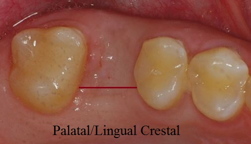 palatal or lingual crestal type incision for implants