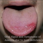 Oral signs and symptoms of iron deficiency anemia