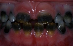 Discoloration of color of teeth - developmental disturbances