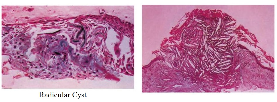 Radicular Cyst with Hyaline bodies histology