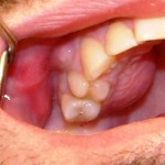 Acute and Chronic Infections of the Oral cavity