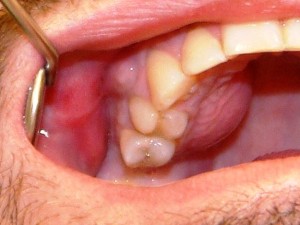 Acute and Chronic Infections of the Oral cavity