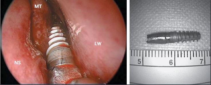 Implant displaced into Sinus cavity