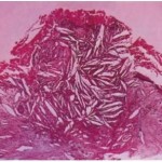Radicular Cysts Histologic features