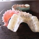 Advantages and Limitations of Removable Orthodontic Appliances